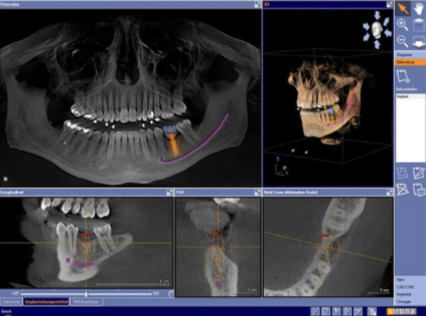 Escáner CBCT dental